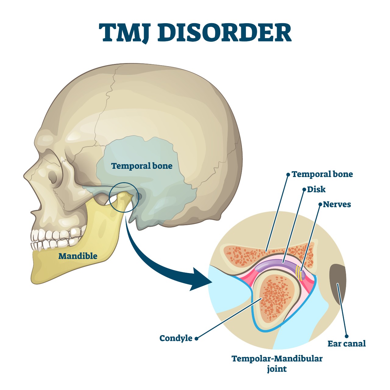 Tmj Disorder Treatment Marietta GA